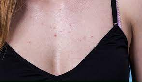 acne on the chest near breast